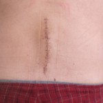 I have a scar like this