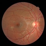 The macula is the dull round area slightly off-center